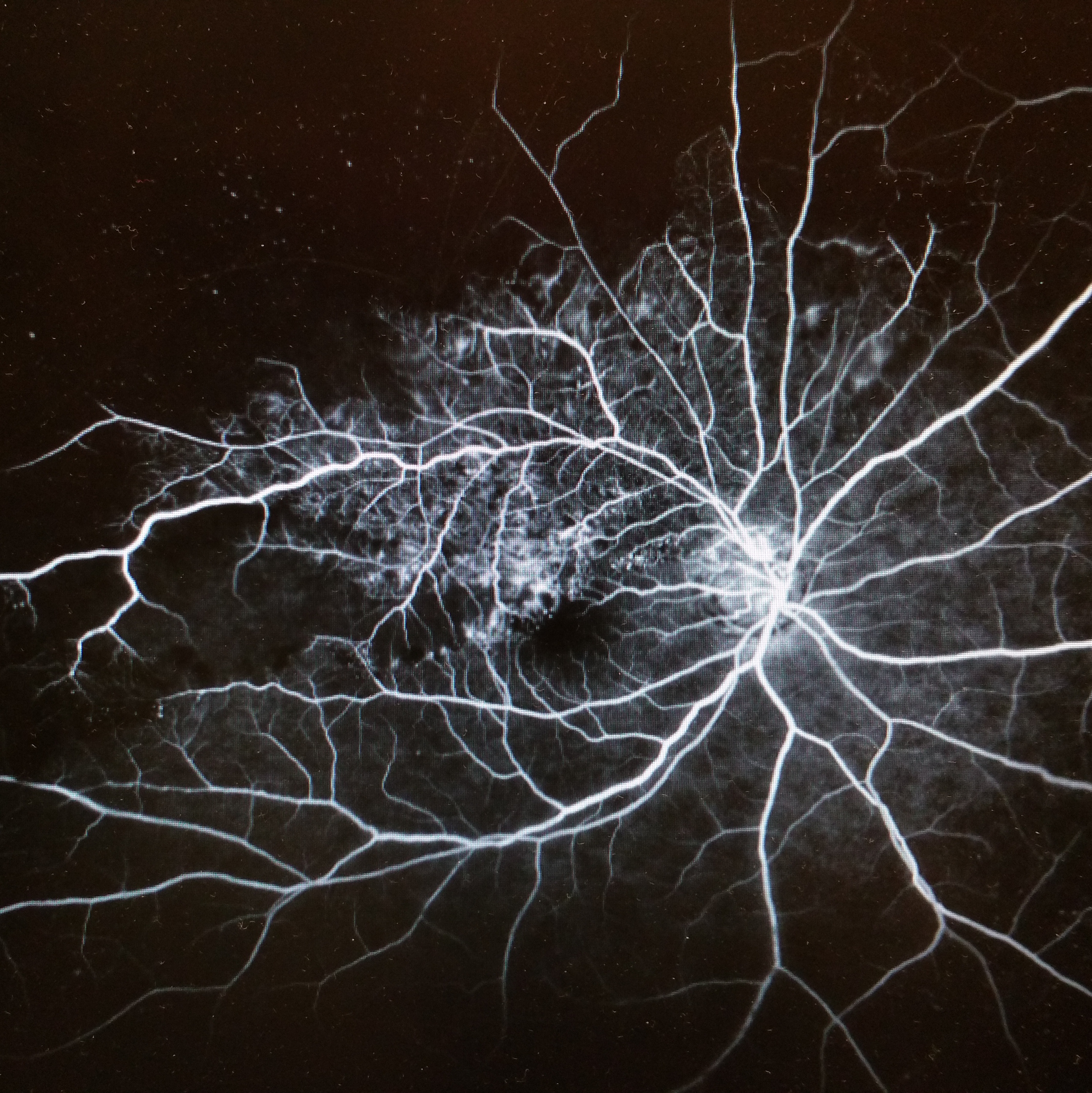 Medical image of a retinal dye test
