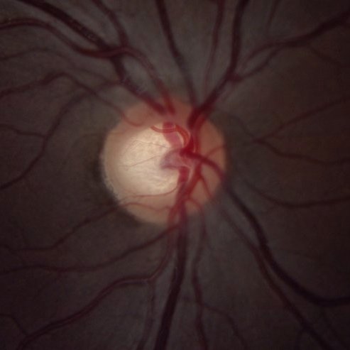 Medical image of an optic nerve